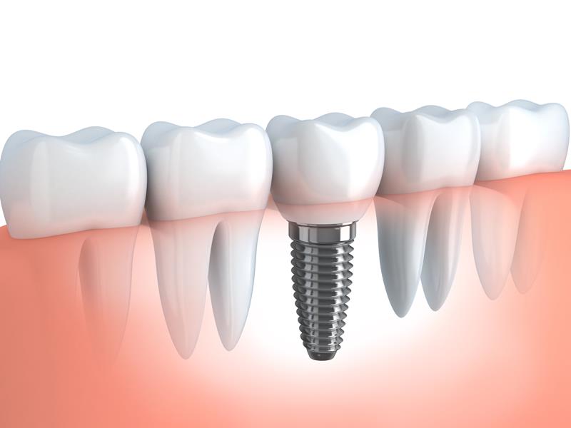 Dental Implants Slidell, LA