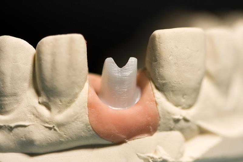 Implant Restoration Slidell, LA