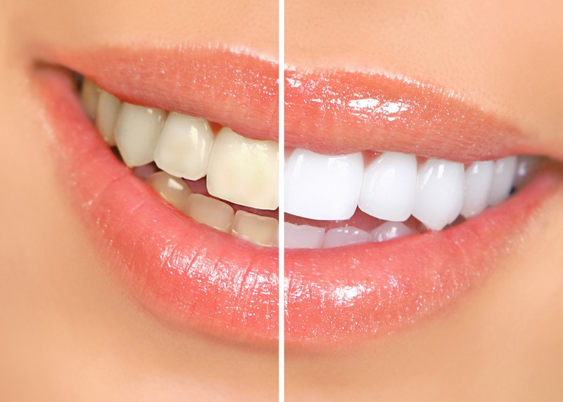 Teeth Whitening Slidell, LA